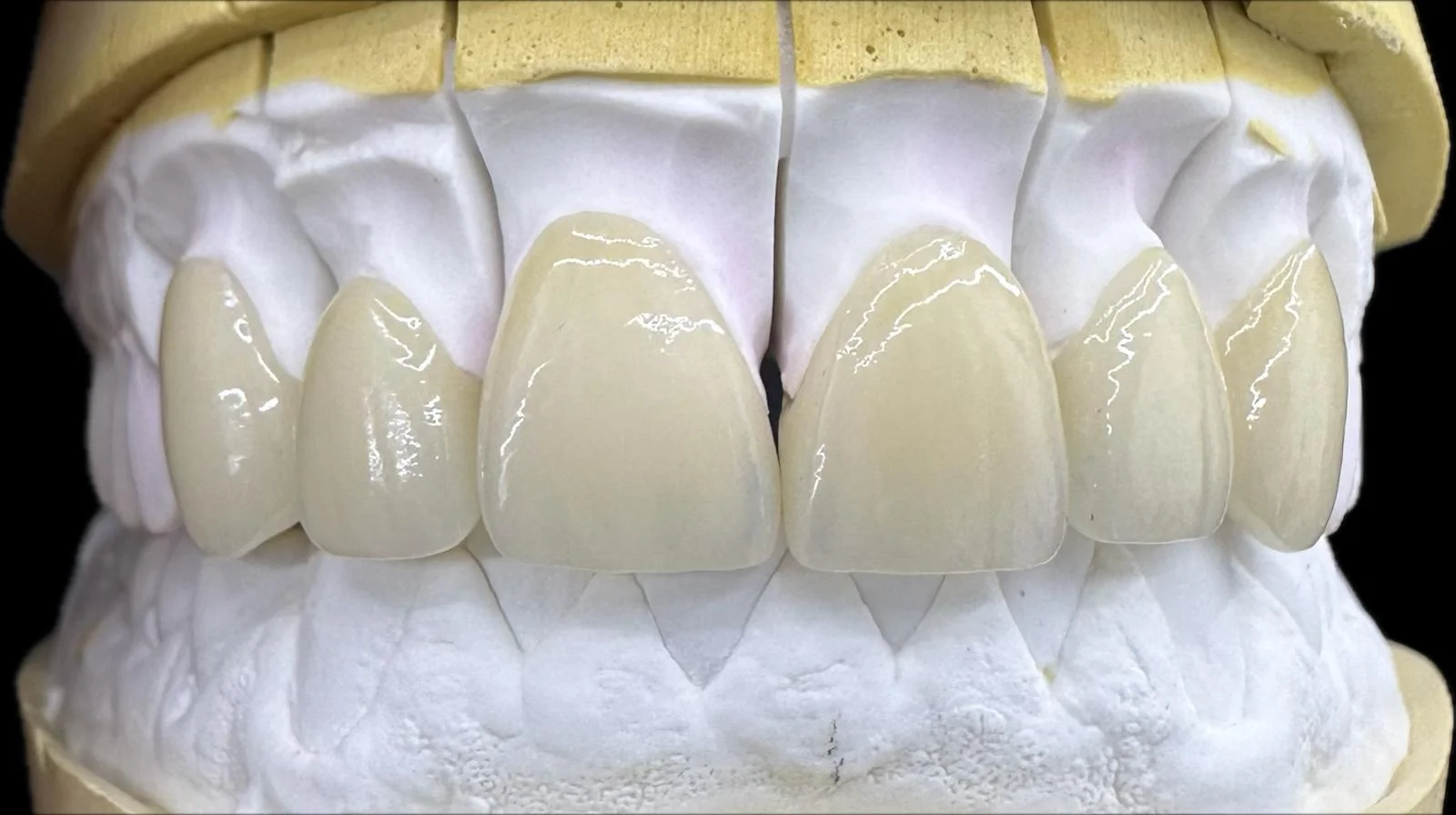 Zircone Stratifiée
