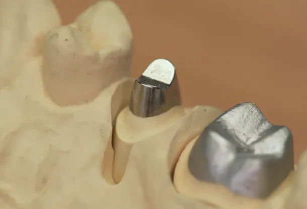 Inlay-Core
