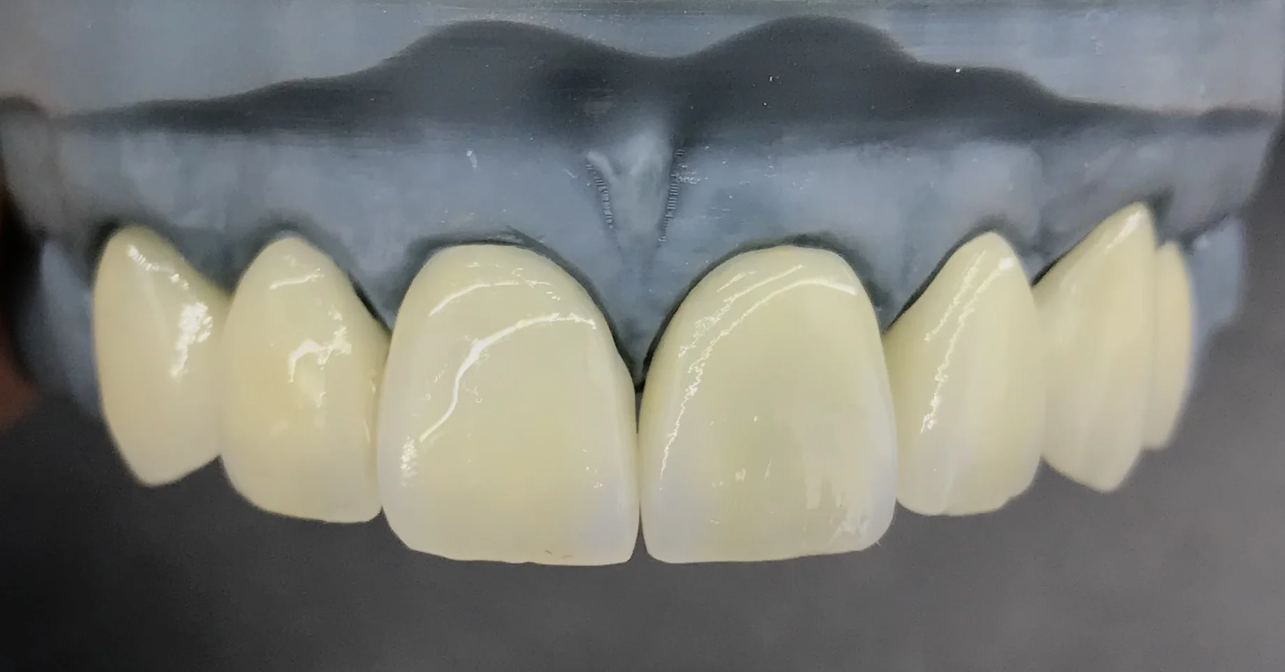 Facettes Stratifiées